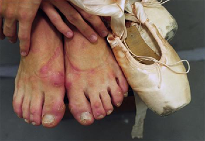 ポイント ワークに痛みは付き物 Does Pointe Work Hurt The Ballet Blog