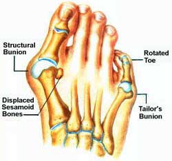 Bunions, Displaced Sesamoids and Rotated Toe - Anatomy Diagram - Lisa Howell - The Ballet Blog