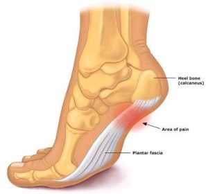 Plantar fasciitis - Anatomy Diagram - Lisa Howell - The Ballet Blog