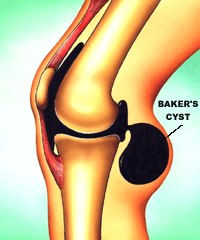 Knee Pain and Bakers Cyst - Anatomy Diagram - Lisa Howell - The Ballet Blog