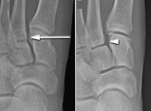 Lisfranc - Foot/Ankle X-Ray - Lisa Howell - The Ballet Blog