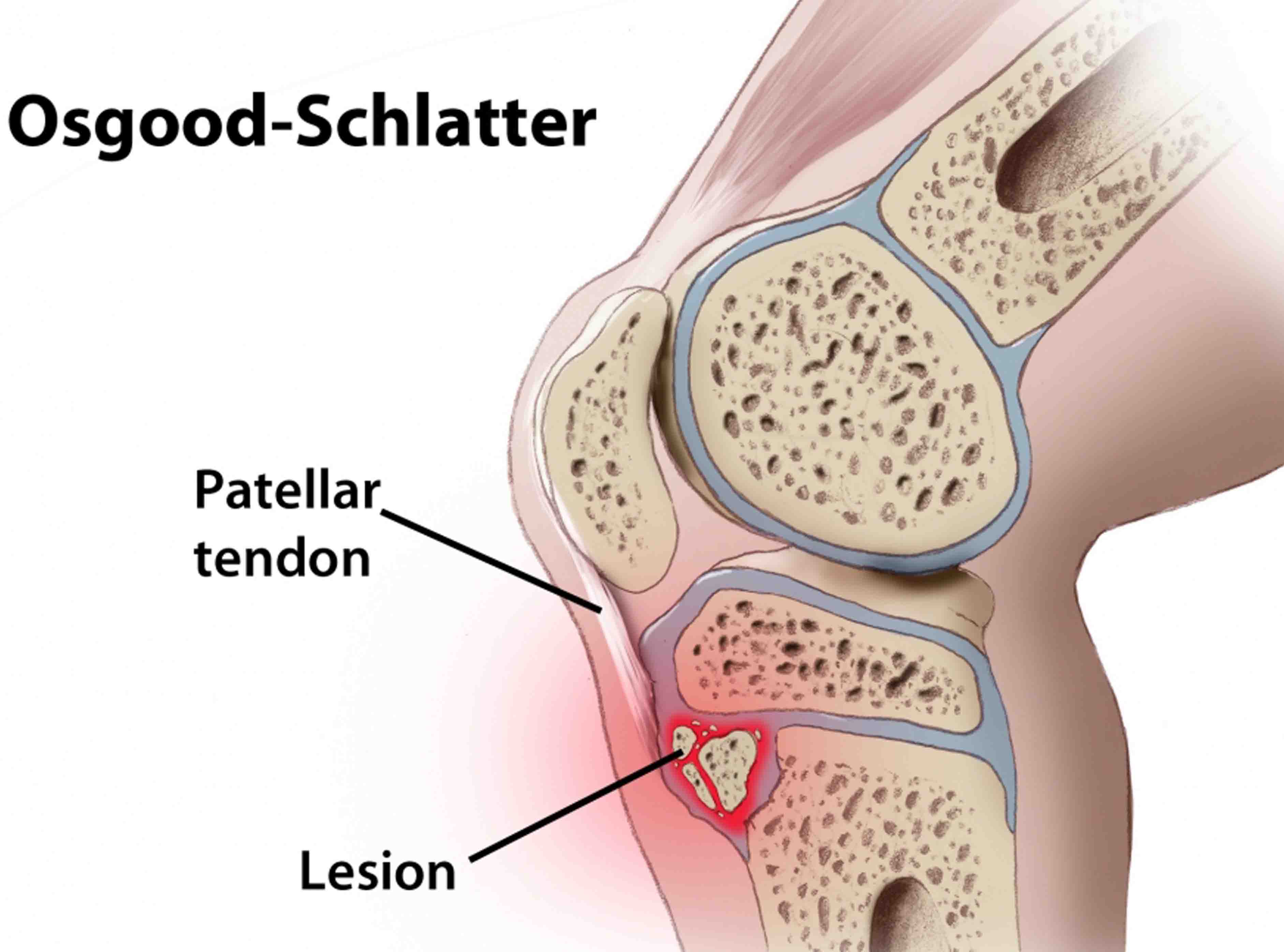 Osood-Schlatters Knee Pain - Anatomy Diagram - Lisa Howell - The Ballet Blog