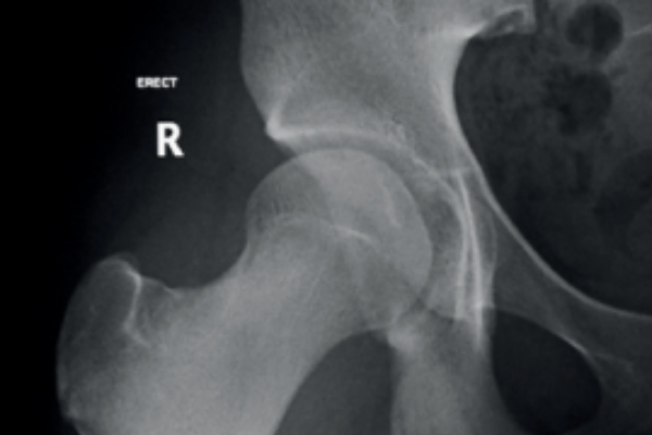 x-ray hip damage lipping- Hip X-Ray - Lisa Howell - The Ballet Blog
