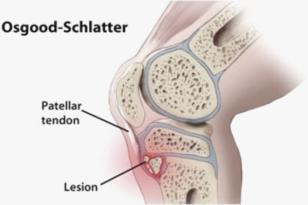 Osood-Schlatters Knee Pain - Idance Injury - Anatomy Diagram - Lisa Howell - The Ballet Blog